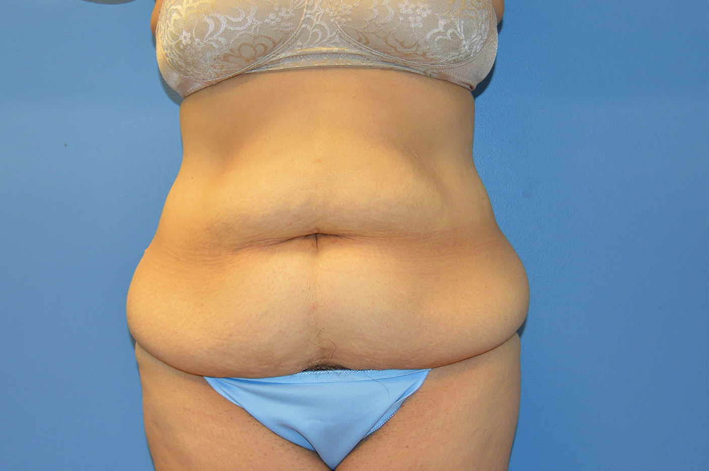 before tummy tuck front view Richmond, VA Zinsser Plastic Surgery