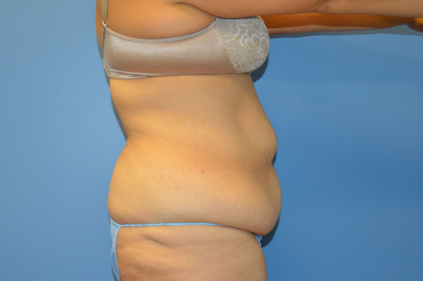 before tummy tuck right view Richmond, VA Zinsser Plastic Surgery