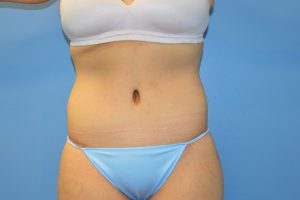 after tummy tuck front view Richmond, VA Zinsser Plastic Surgery