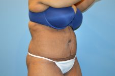 after tummy tuck right angle view Richmond, VA Zinsser Plastic Surgery