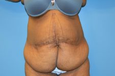 before tummy tuck front view Richmond, VA Zinsser Plastic Surgery