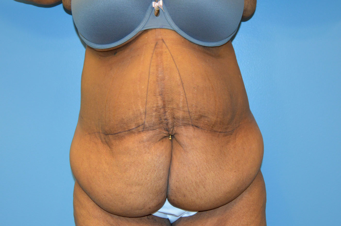 before tummy tuck front view Richmond, VA Zinsser Plastic Surgery
