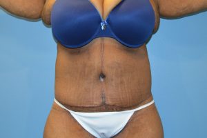 after tummy tuck front view Richmond, VA Zinsser Plastic Surgery