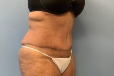 after tummy tuck right angle view Richmond, VA Zinsser Plastic Surgery