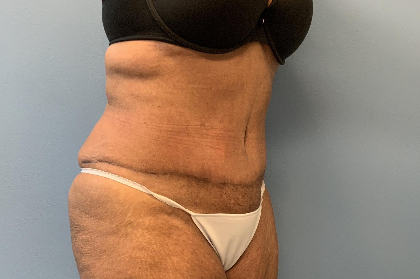 after tummy tuck right angle view Richmond, VA Zinsser Plastic Surgery