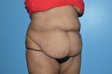 before tummy tuck right angle view Richmond, VA Zinsser Plastic Surgery