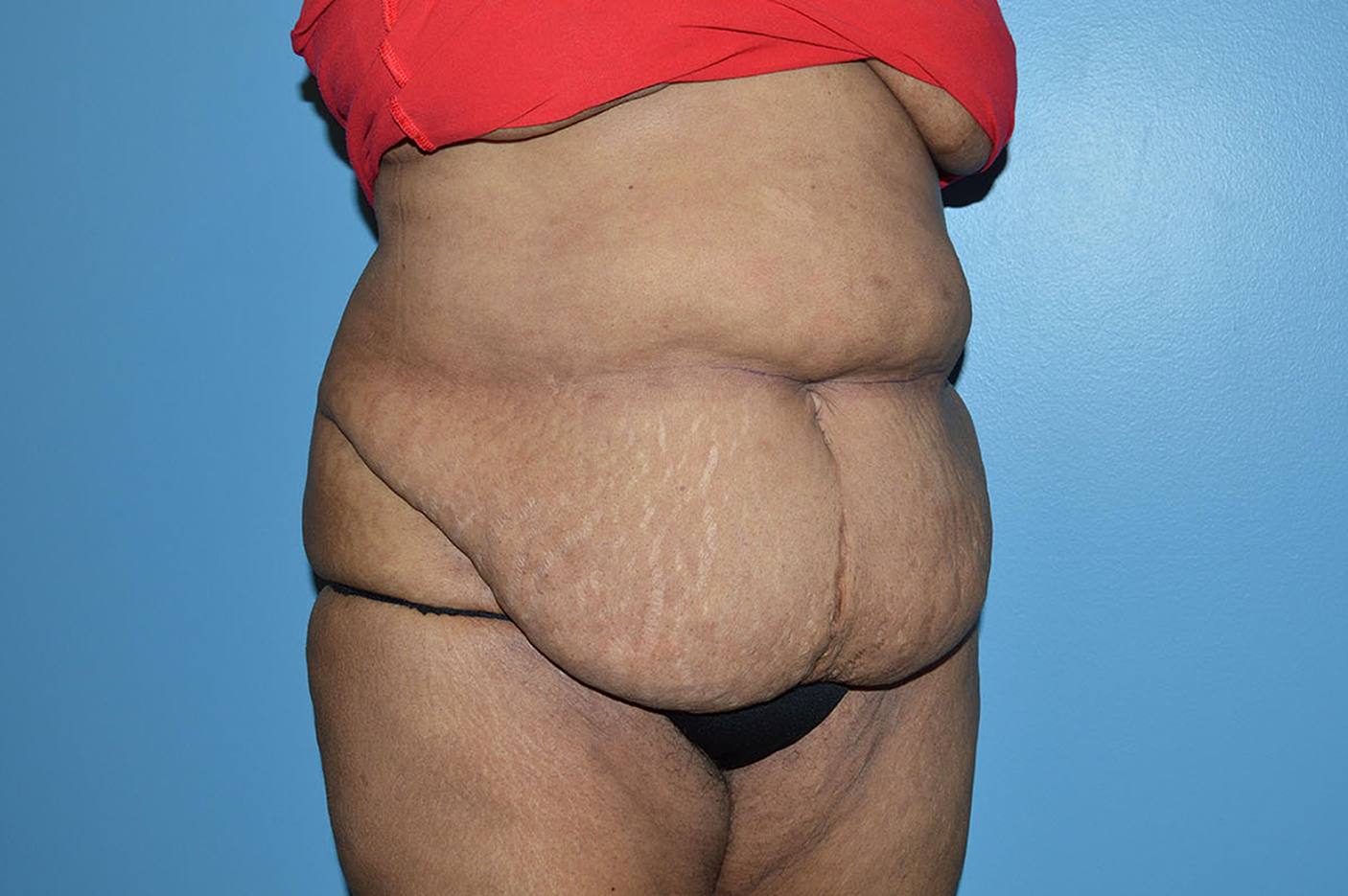 before tummy tuck right angle view Richmond, VA Zinsser Plastic Surgery