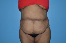 before tummy tuck front view Richmond, VA Zinsser Plastic Surgery
