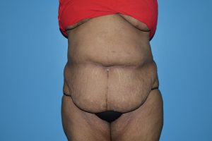 before tummy tuck front view Richmond, VA Zinsser Plastic Surgery