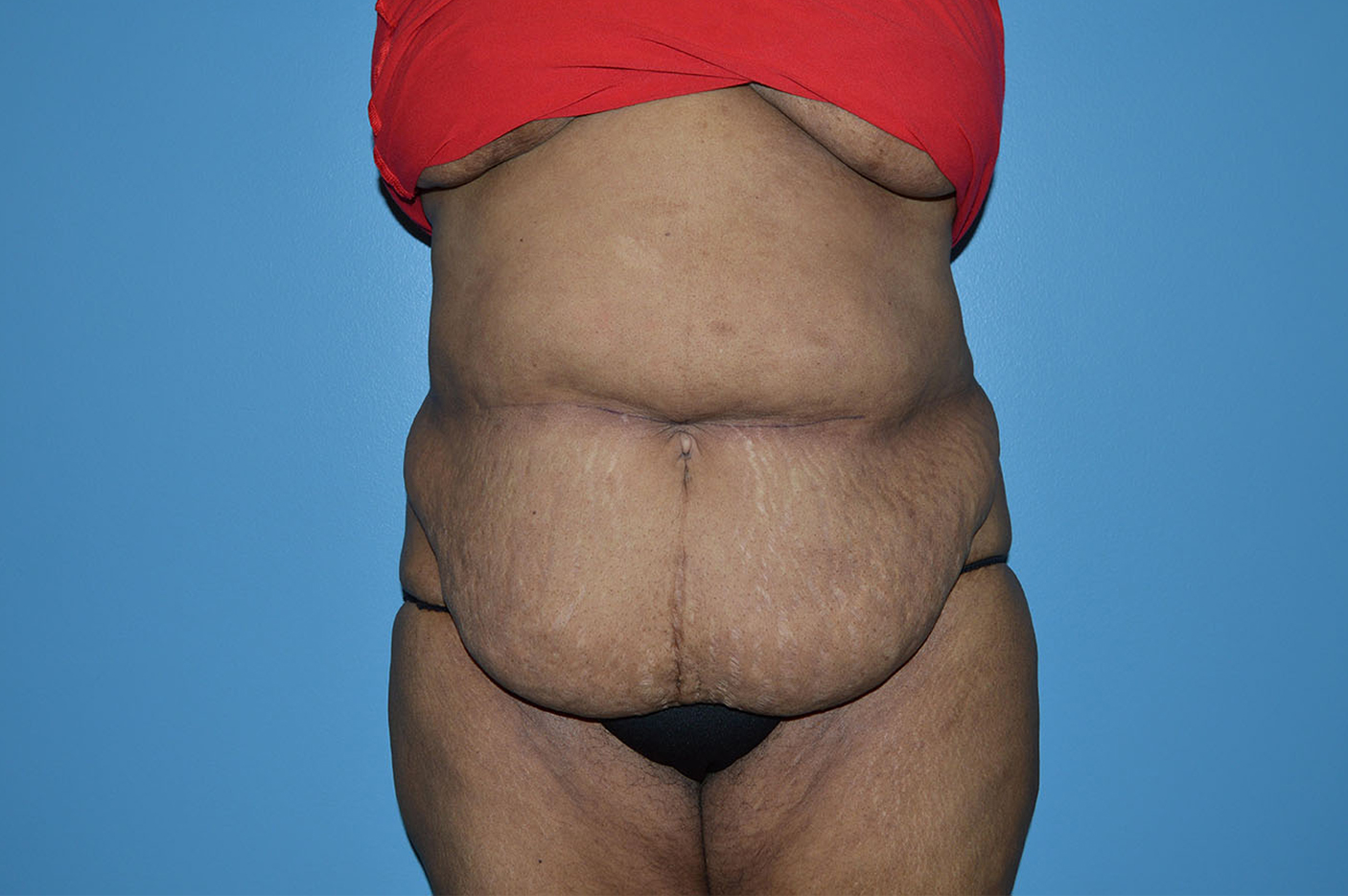 before tummy tuck front view Richmond, VA Zinsser Plastic Surgery