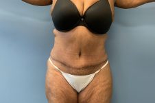 after tummy tuck front view Richmond, VA Zinsser Plastic Surgery