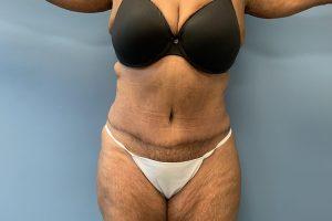 after tummy tuck front view Richmond, VA Zinsser Plastic Surgery