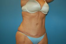 after tummy tuck right angle view Richmond, VA Zinsser Plastic Surgery