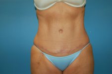 after tummy tuck front view Richmond, VA Zinsser Plastic Surgery