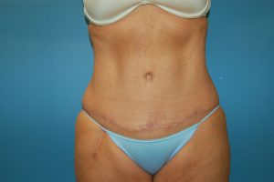 after tummy tuck front view Richmond, VA Zinsser Plastic Surgery