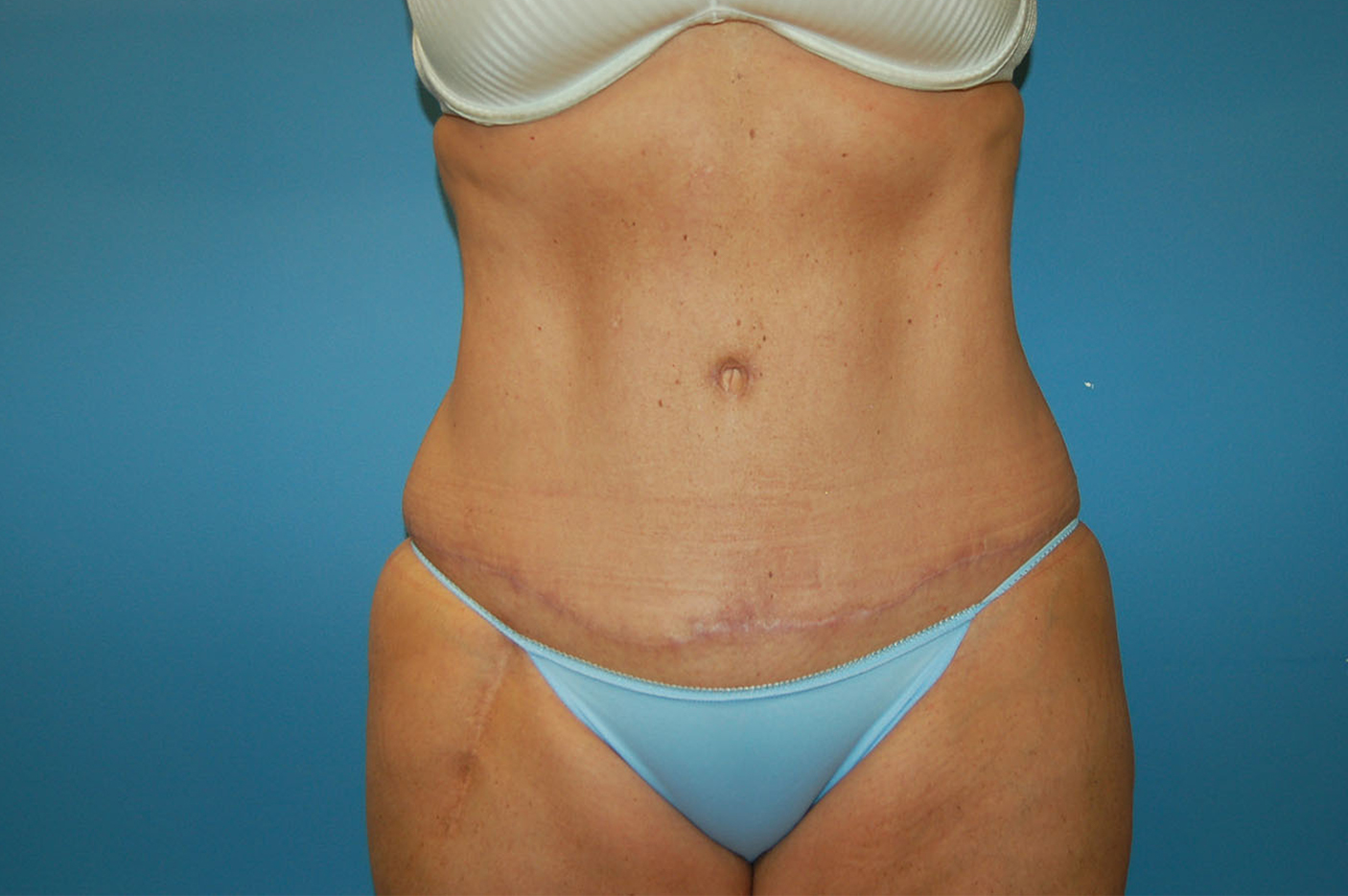 after tummy tuck front view Richmond, VA Zinsser Plastic Surgery