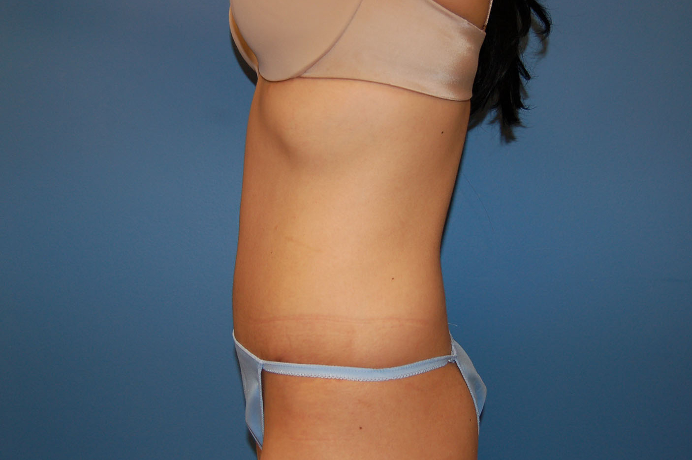 after tummy tuck left view Richmond, VA Zinsser Plastic Surgery