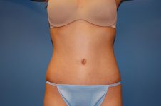 after tummy tuck front view Richmond, VA Zinsser Plastic Surgery