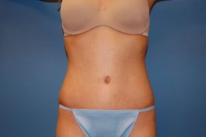 after tummy tuck front view Richmond, VA Zinsser Plastic Surgery