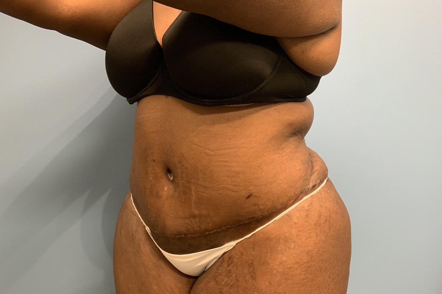 after tummy tuck left angle view Richmond, VA Zinsser Plastic Surgery