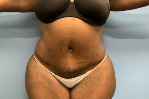 after tummy tuck front view Richmond, VA Zinsser Plastic Surgery