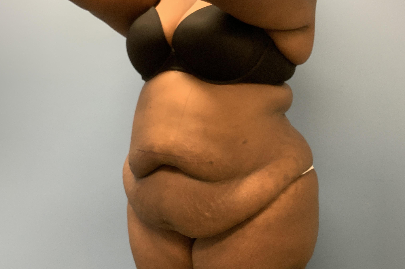 before tummy tuck left angle view Richmond, VA Zinsser Plastic Surgery