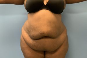 before tummy tuck front view Richmond, VA Zinsser Plastic Surgery
