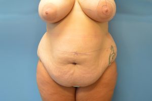 before tummy tuck front view female patient case 3377