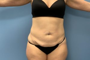 before tummy tuck front view female patient case 3747