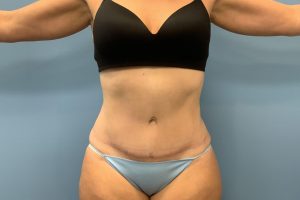 after tummy tuck front view female patient case 3747