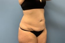 before tummy tuck diagonal view female patient case 3747