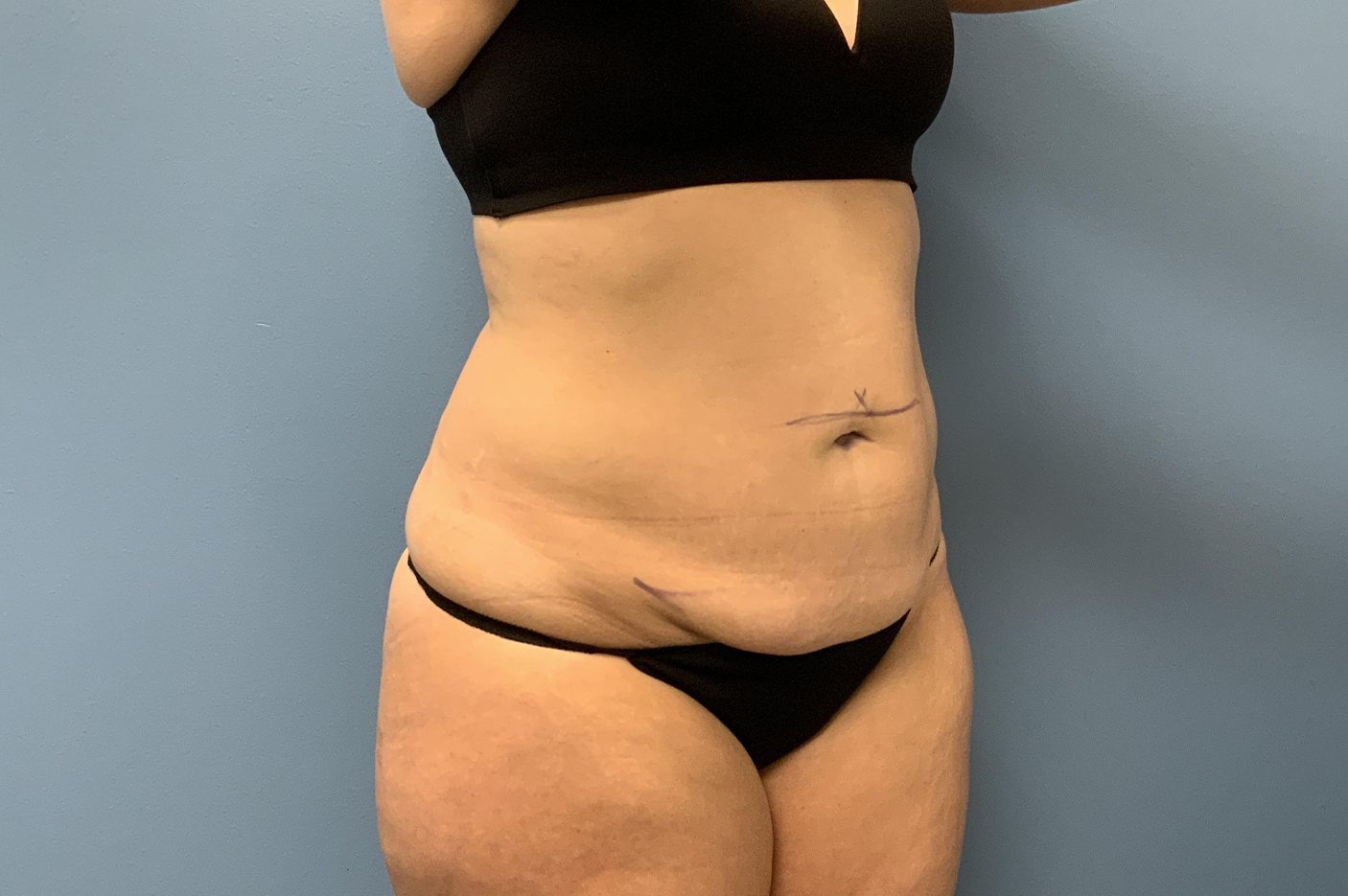before tummy tuck diagonal view female patient case 3747