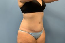 after tummy tuck diagonal view female patient case 3747