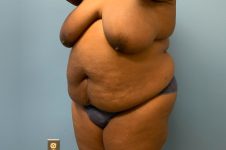Before tummy tuck angle view female patient case 4011