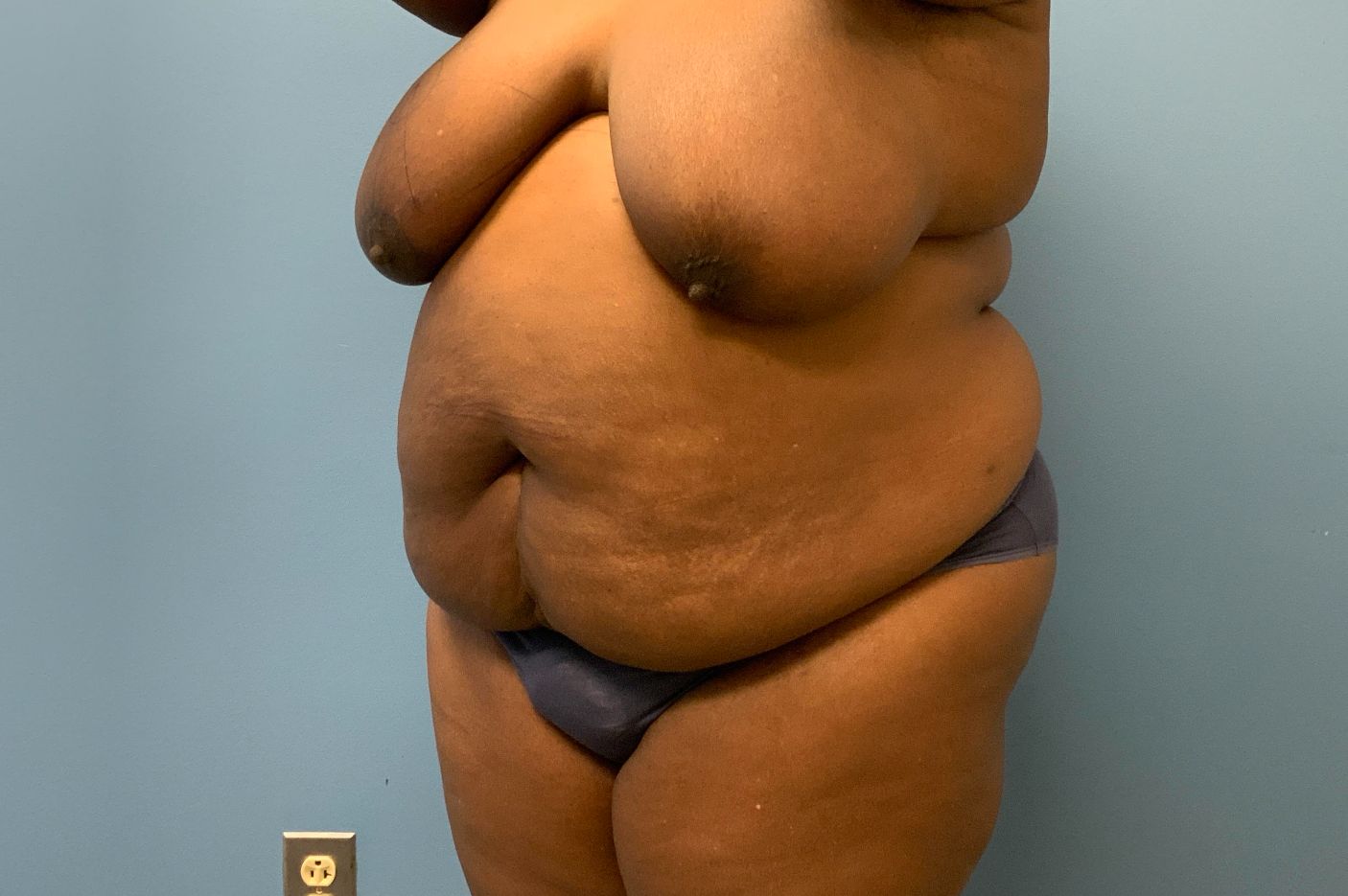 Before tummy tuck angle view female patient case 4011