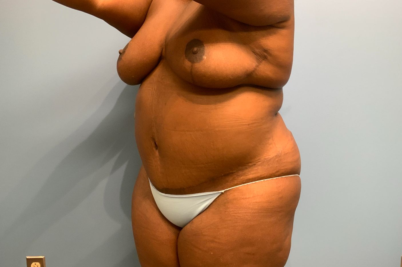 After tummy tuck angle view female patient case 4011