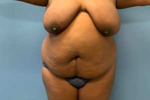before tummy tuck front view female patient case 4011