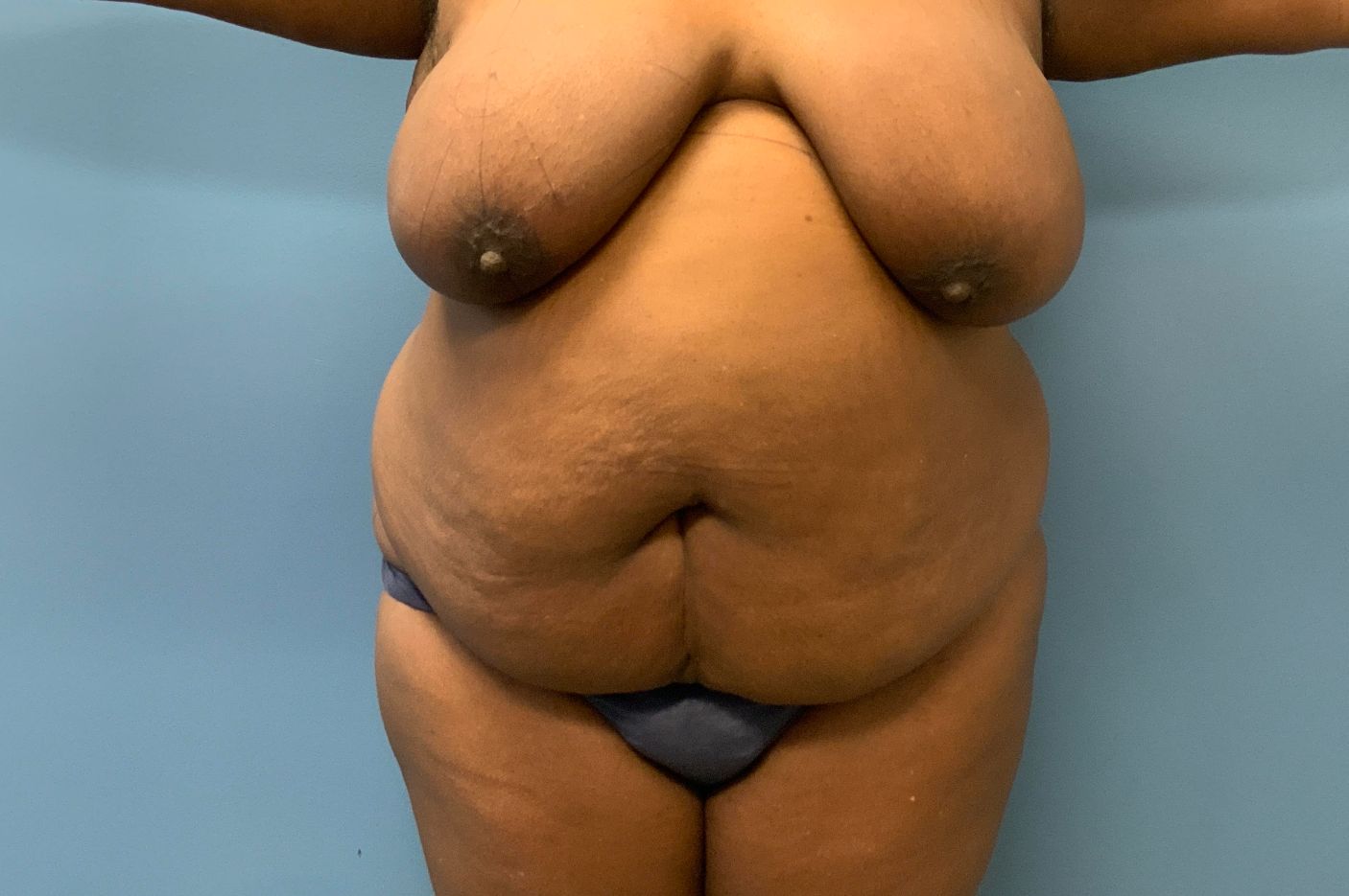 before tummy tuck front view female patient case 4011