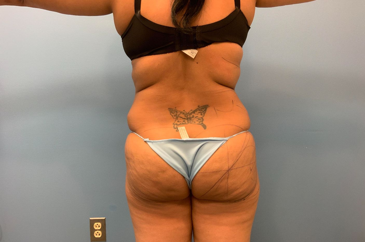 before brazilian butt lift back view female patient case 42771