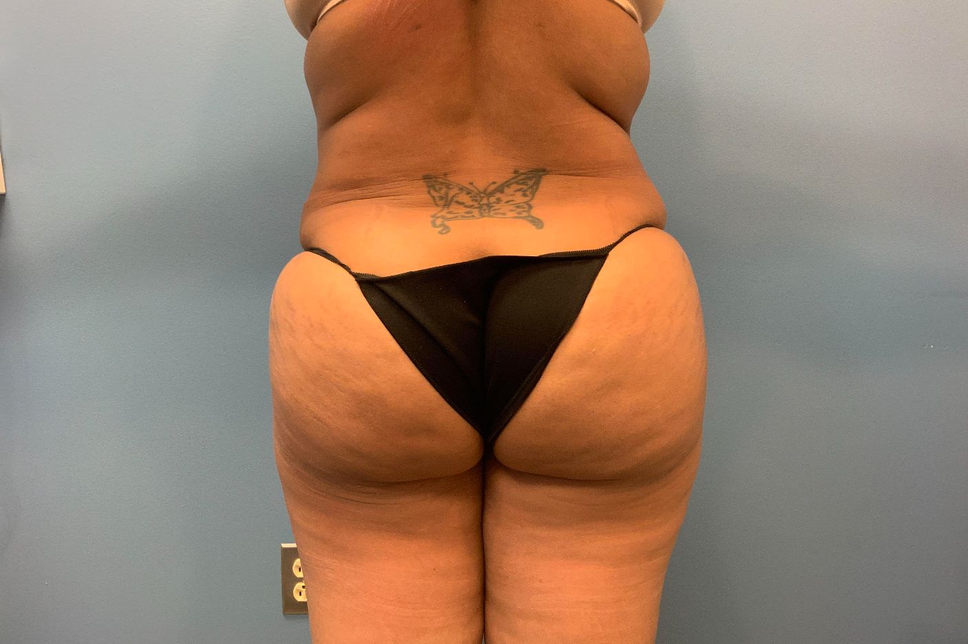 after brazilian butt lift back view female patient case 42771