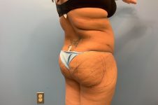 before brazilian butt lift back right angle view female patient case 42771