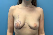 before breast augmentation front view female patient case 4302