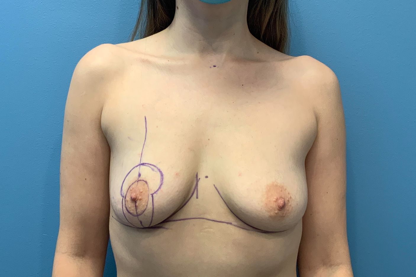 before breast augmentation front view female patient case 4302