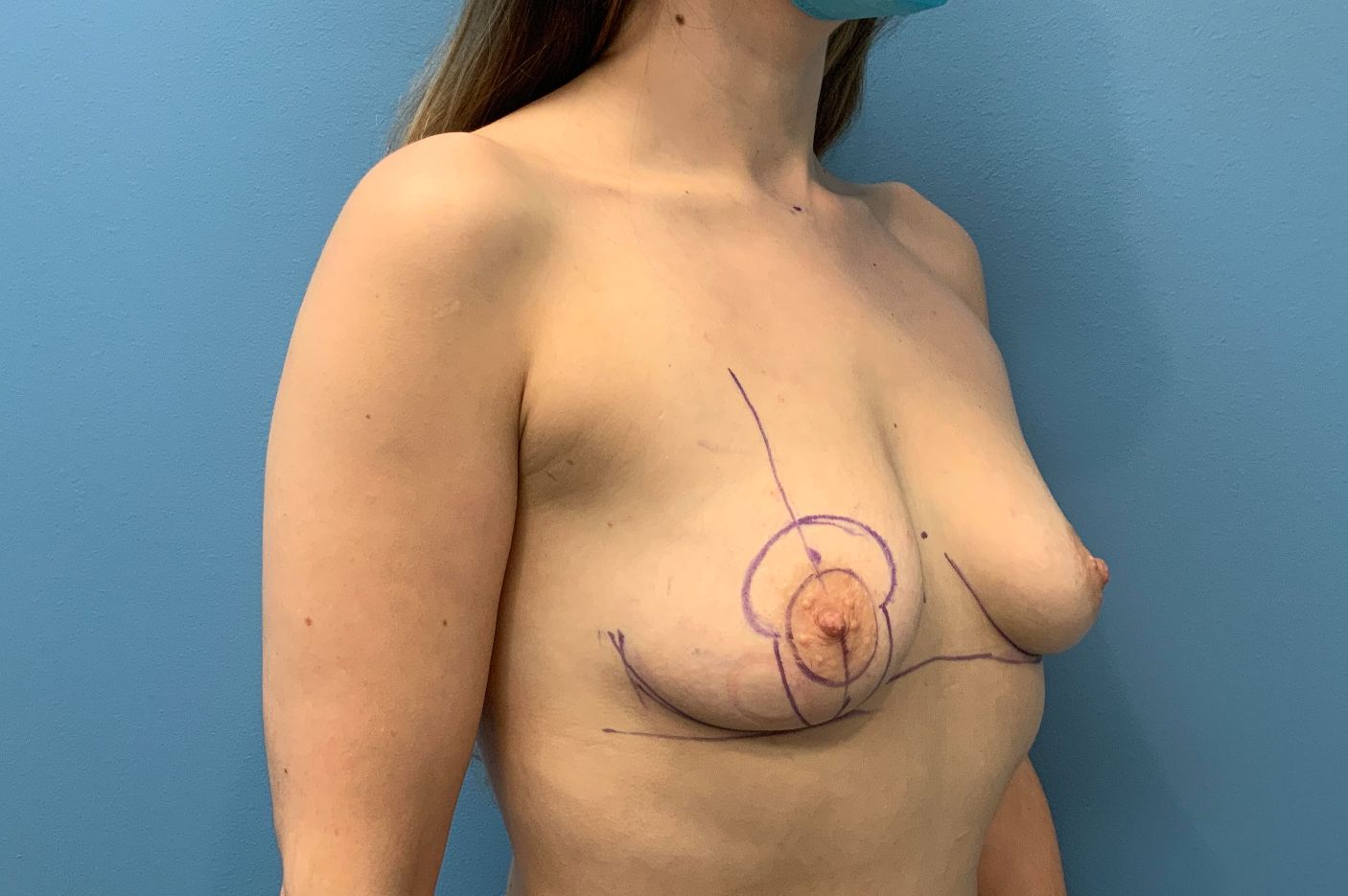 before breast augmentation right angle view female patient case 4302
