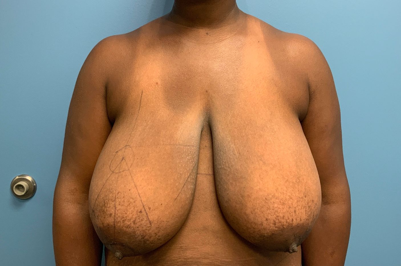 before breast lift front view female patient case 4307