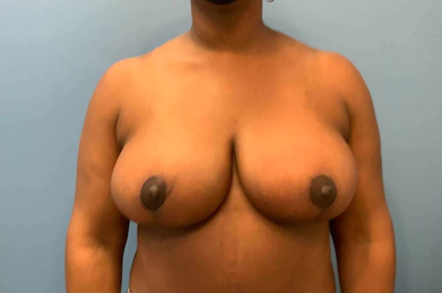 after breast lift front view female patient case 4307