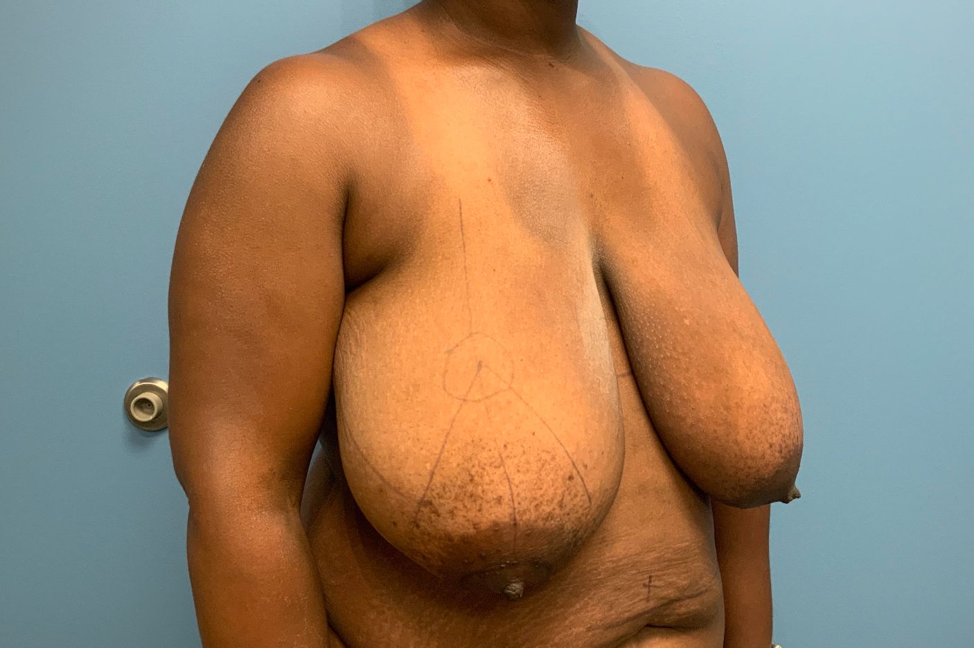 before breast lift right angle view female patient case 4307