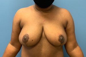 after breast reduction front view female patient case 4277