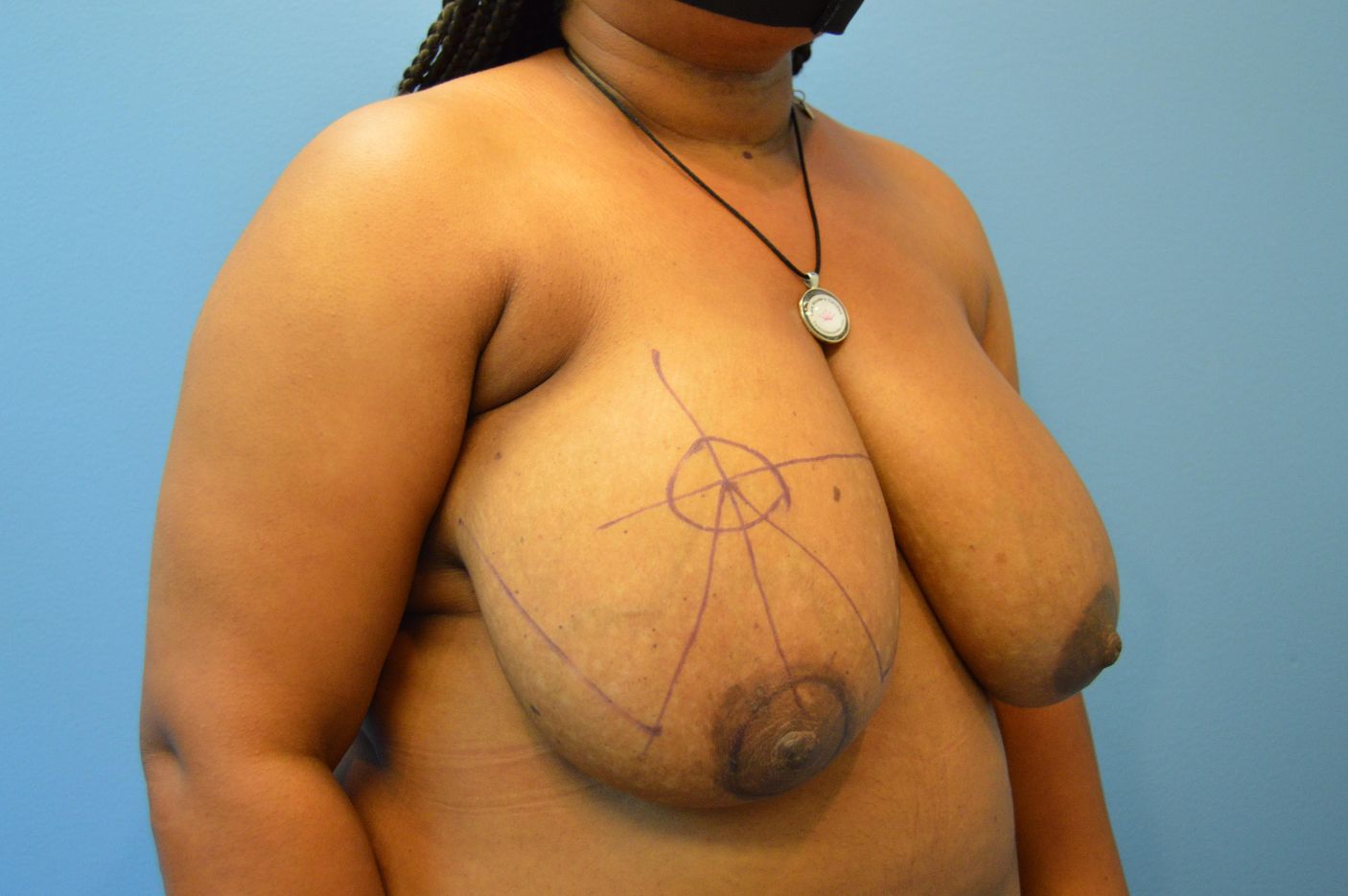 before breast reduction right angle view female patient case 4277