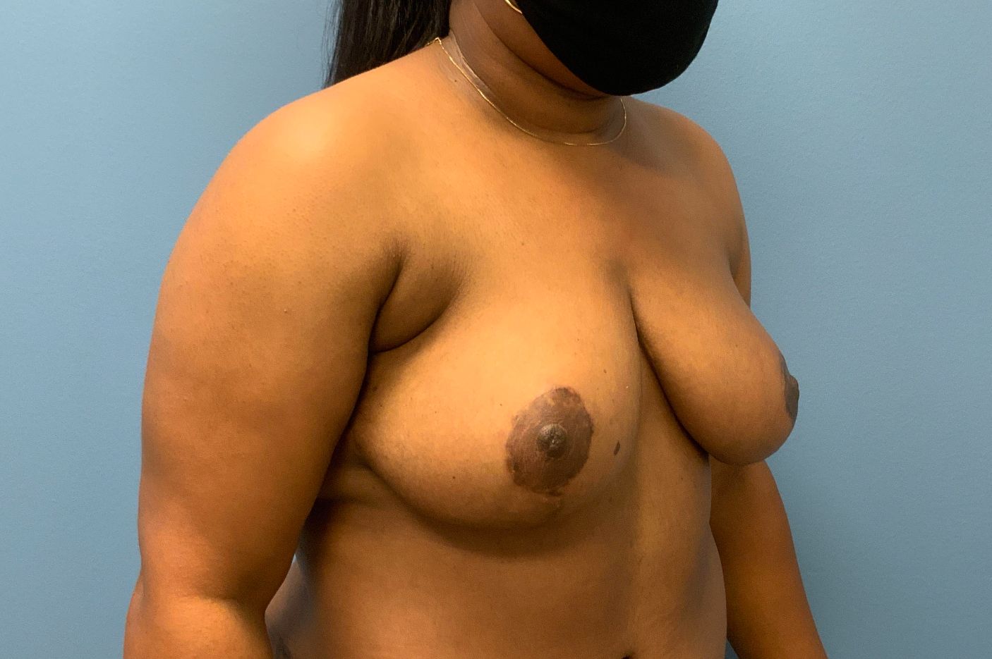 after breast reduction right angle view female patient case 4277